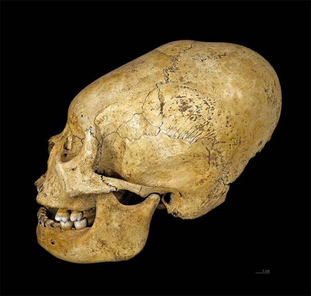 Cráneo deformado de Proto Nazca, alrededor del 200 al 100 a. (CC BY-SA 4.0)