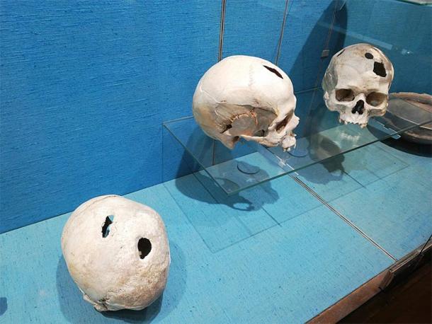Bronze Age skulls with evidence of trephination found at Comps-sur-Artuby, France, in 1983. On show at the Archaeological Museum of Saint-Raphaël, France. (Wisi eu / CC BY-SA 4.0)