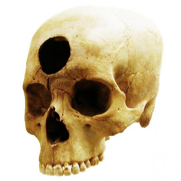 Another Peruvian skull found with evidence of the trephination surgery from 2000 years ago presumably to relieve a front cavity inflammation. (tsaiproject / CC BY 2.0)