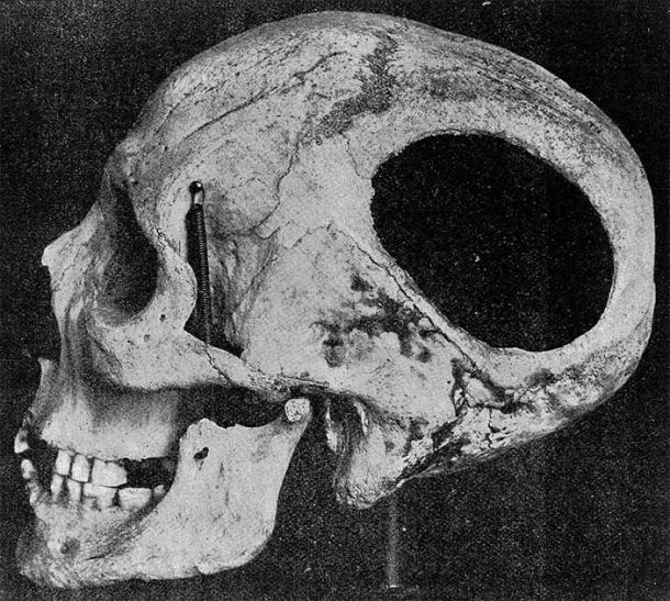 Skull with evidence of trephination from the cave of Nogent-les-vierges, France, Neolithic period. (Wellcome Images / CC BY 4.0)