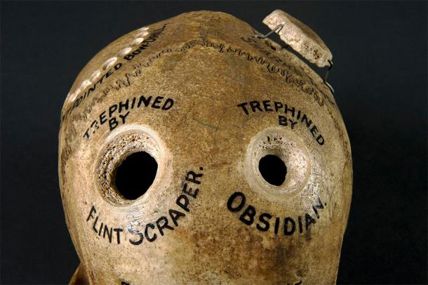 Human skull illustrating different methods of trephination. ((Wellcome Images / CC BY 4.0 )
