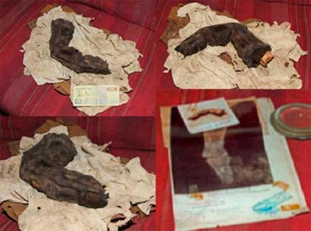 More images of the finger, including an x-ray that was done in the 1960s. (Courtesy of ©Gregor Sporri).