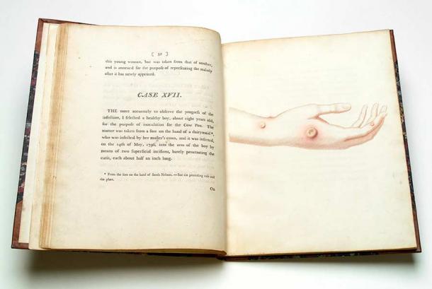 An inquiry by Edward Jenner into the causes and effects of the variolae vaccinae : a disease discovered in some of the western counties of England, particularly Gloucestershire, and known by the name of the cowpox. (Wellcome Collection / Public Domain Mark 1.0)