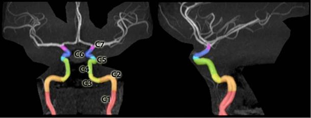 Segments of the internal carotid artery at the base of the skull that allow arteries to pass to the brain, delineated on an MRA of the head. 