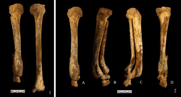 These leg bones found in a 3,000-year-old grave in China show evidence of foot amputation as punishment according to the latest research. (South China Morning Post)