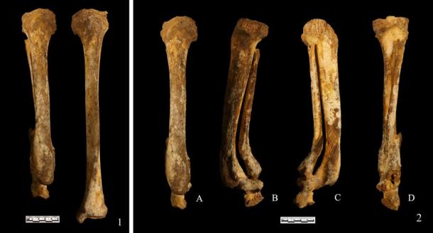 Estos huesos de la pierna encontrados en una tumba de 3.000 años de antigüedad en China muestran evidencia de amputación del pie como castigo según las últimas investigaciones. (Correo de la mañana del sur de China)