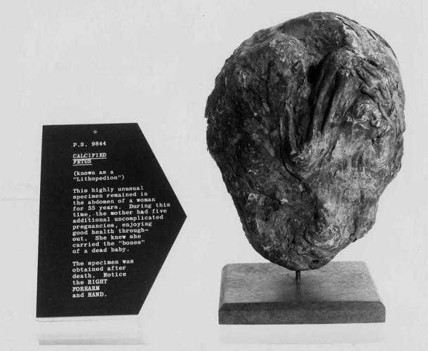 A lithopedion. This highly unusual specimen remained in the abdomen of a woman for 55 years. During this time the mother had five additional uncomplicated pregnancies. 