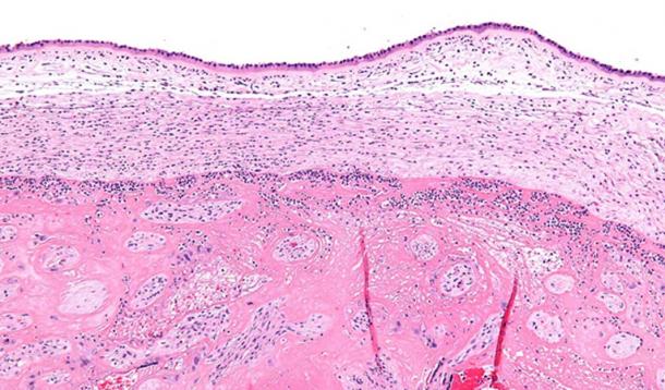 High magnification micrograph chorioamnionitis.