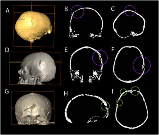 A-C: Cioclovina, D-F: modern cranium with perimortem trauma (data obtained from the archives of the Department of Radiology, Heraklion University Hospital, Crete, Greece with permission), G-I: archaeological cranium with post-mortem damage (medieval specimen from the Ballumbie Collection, Department of Archaeology, University of Edinburgh, Scotland). Note the plastic deformation of the perimortem fractures in the 2-dimensional figures (B, C, E and F) compared to the sharp edges at right angles to the bone surface indicating post-mortem damage (H and I).( Kranoti et al / Plos One)