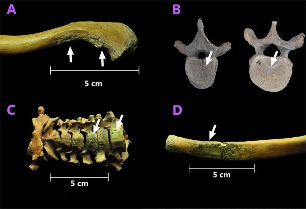 Some osteological findings for individual 150 (SJN001). A. Exostosis at the insertion of the coracoclavicular ligament and origin site of the deltoid muscle. B. Thoracic vertebra displaying early signs of a developing of Schmörl's hernia on the inferior aspect of the vertebral body. C. Green coloration acquired by contact with copper on the cervical vertebrae. D. Green coloration acquired by contact with copper on the costal end of a rib diaphysis. (Image: Collection of San José de los Naturales, Osteology Laboratory, (ENAH), Mexico City, Mexico. Photo: R. Barquera & N. Bernal.)