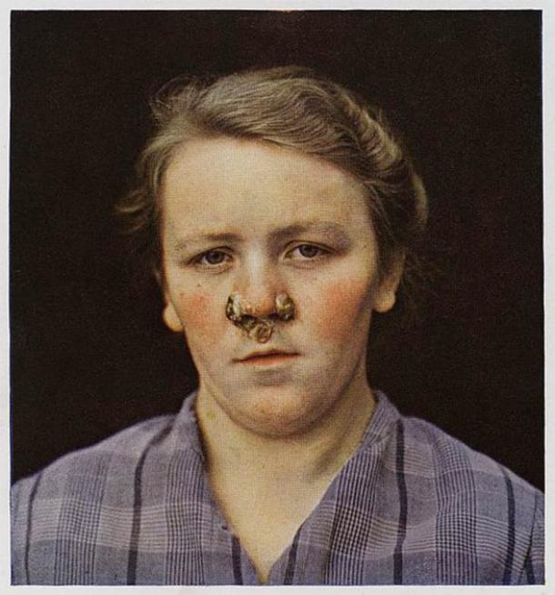 A photograph of a girl suffering from secondary Syphilis to the face with large papules around the nose. (CC BY 4.0)