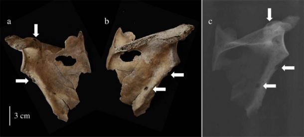 Los restos óseos que datan de la Edad del Bronce en China han sido analizados por un equipo de investigación internacional. Usando una combinación de fotografía y rayos X, encontraron lesiones osteolíticas sin esclerosis. Finalmente concluyeron que estos restos son el primer caso de mieloma múltiple descubierto hasta la fecha en el este de Asia. (Jenna Dittmar/Ciencia directa)