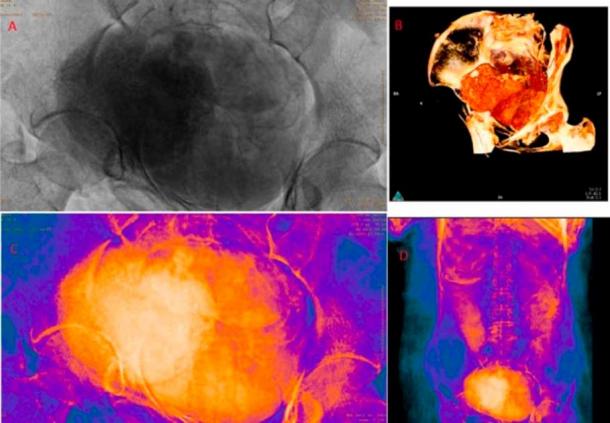 These scans show what appeared to be a fetus in the pelvis region. (Journal of Archaeological Science )