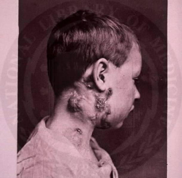 A patient suffering from scrofula (Unknown Author / Public Domain)