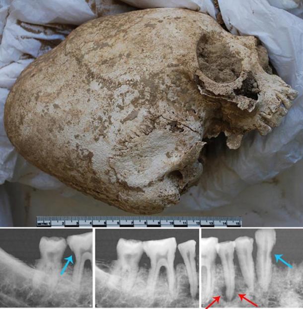 Artificially deformed skull; X-rays of right mandible with tooth decay and infected bone