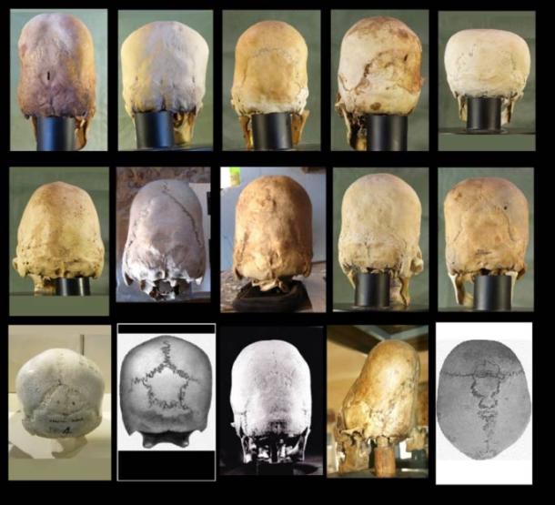 The Paracas skulls have variations in the occipital bone compared to modern-day human skulls