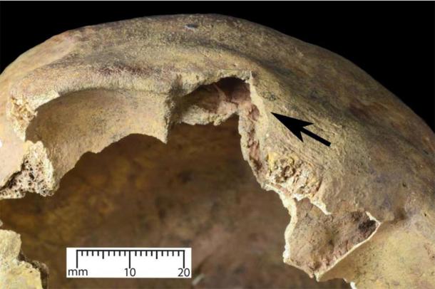 A square-shaped wound seen just over the right eye on the cranium, which was inflicted by a medieval longbow. (Oliver Creighton / University of Exeter)