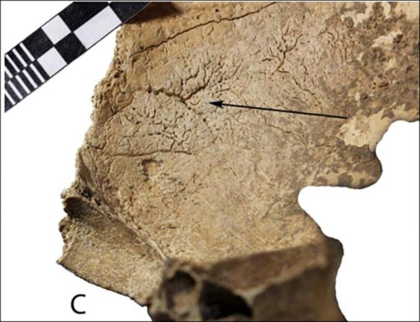 The left parietal bone had an opening with evident signs of bone healing, as well as indications of an inflammatory reaction on the bone plates.