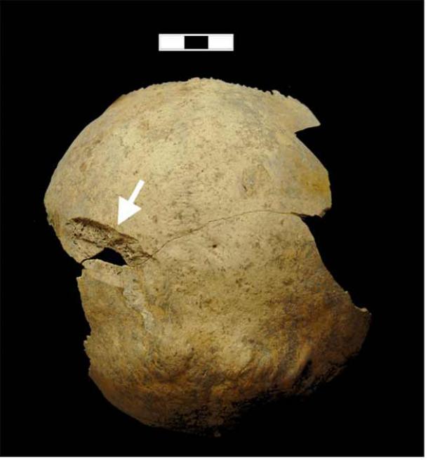 Sword wounds to the back of a crusaders head reveal the extreme violence that resulted in the two mass crusaders graves found in Sidon, Lebanon. (Richard Mikulski / PLOS One)