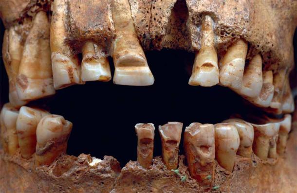Detail of filed teeth from one of the graves on Gotland. Teeth filing is another example of the bizarre Viking body modification customs that existed during the Viking age. (Lisa Hartzell / Current Swedish Archaeology / CC BY 2.5 SE)