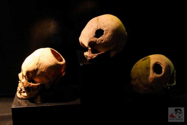 Three trepanned patients from Peru.  These surgical marks are quite different from the trephined skull recently discovered in Turkey.  (Paulo Guereta / CC BY 2.0)