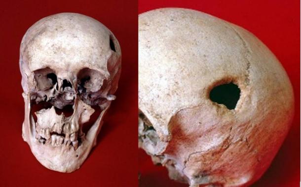 Medieval man may have had head drilled in an exorcism