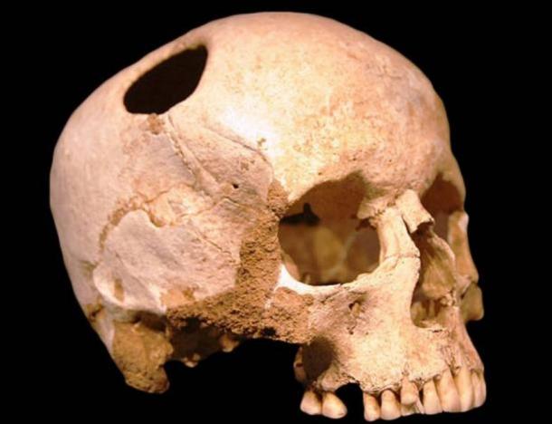 The trepanned skull of a medieval or Saxon man found in Italy.