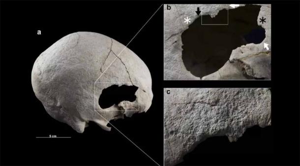 Woman Who Lived in Spain 4,500 Years Ago Survived Two Radical Head Surgeries