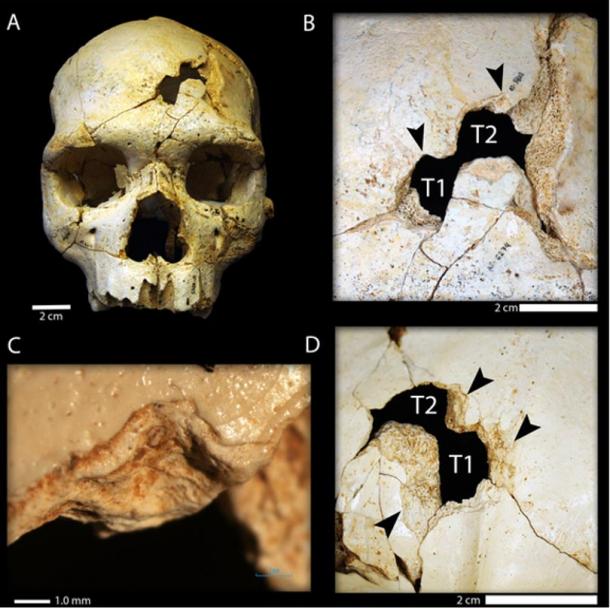 Researchers say the differing orientation of the two wounds to the cranium (T1 and T2) indicate there were two blows, which means they were inflicted rather than sustained in an accident. 