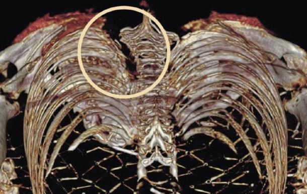 X-ray showing stab wound of Ireland’s Egyptian mummy Takabuti. (R.D. Loynes / The University of Manchester)