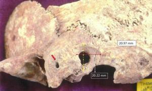 Ectocranial view of the brain surgery of paleopathological specimen: a) red arrow points to orifice on the mastoid process, and b) surgical preparation dimensions peripheral to trephination. Source: Anagnostis P. Agelarakis / Adelphi University