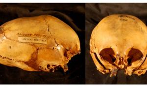 Elongated Skulls in utero - Morton Collection