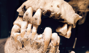 Ancient Dentistry - golden teeth