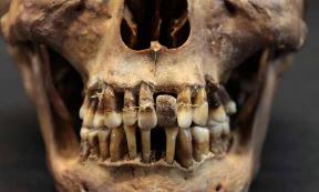 The Skull of Anne d’Alegre, countess of Laval (1565-1619) equipped with hippo bone dental prostheses and gold wire. Source: Rozenn Collator / Inrap