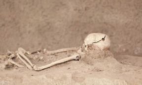 Skeleton with a hole in the skull.  Source: wellphoto/Shutterstock.com via The Conversation