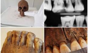 Top, an X-ray image reveals carious lesions on posterior molars. Bottom, a filed hole from the crown of the tooth into the pulp. Source: Carolina Bertilsson and Henrik Lund/PLoS ONE