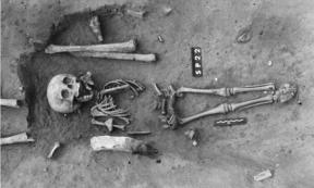 Ancient burial of a child with Down syndrome