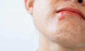 Study has found that human herpes was spread by kissing throughout history. Source: boyloso / Adobe Stock