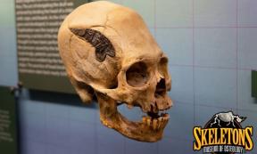 The elongated skull of a Peruvian warrior who underwent skull surgery 2,000 years ago. Source: Museum of Osteology