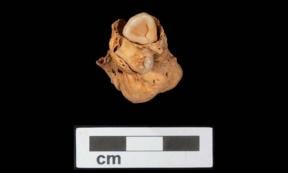 The teratoma tumor, including teeth, which was discovered within the Amarna crypt. Source: A. Deblauwe / Amarna Project