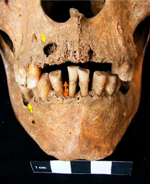 Los dientes del portugués del siglo XI d. C., que padecía el síndrome de Klinefelter, eran más largos que la media y sufría una enfermedad debilitante de las encías. (La lanceta)
